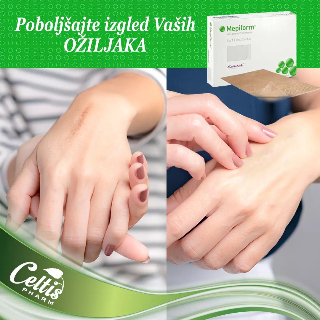MEPIFORM silikonski flasteri za ožiljke